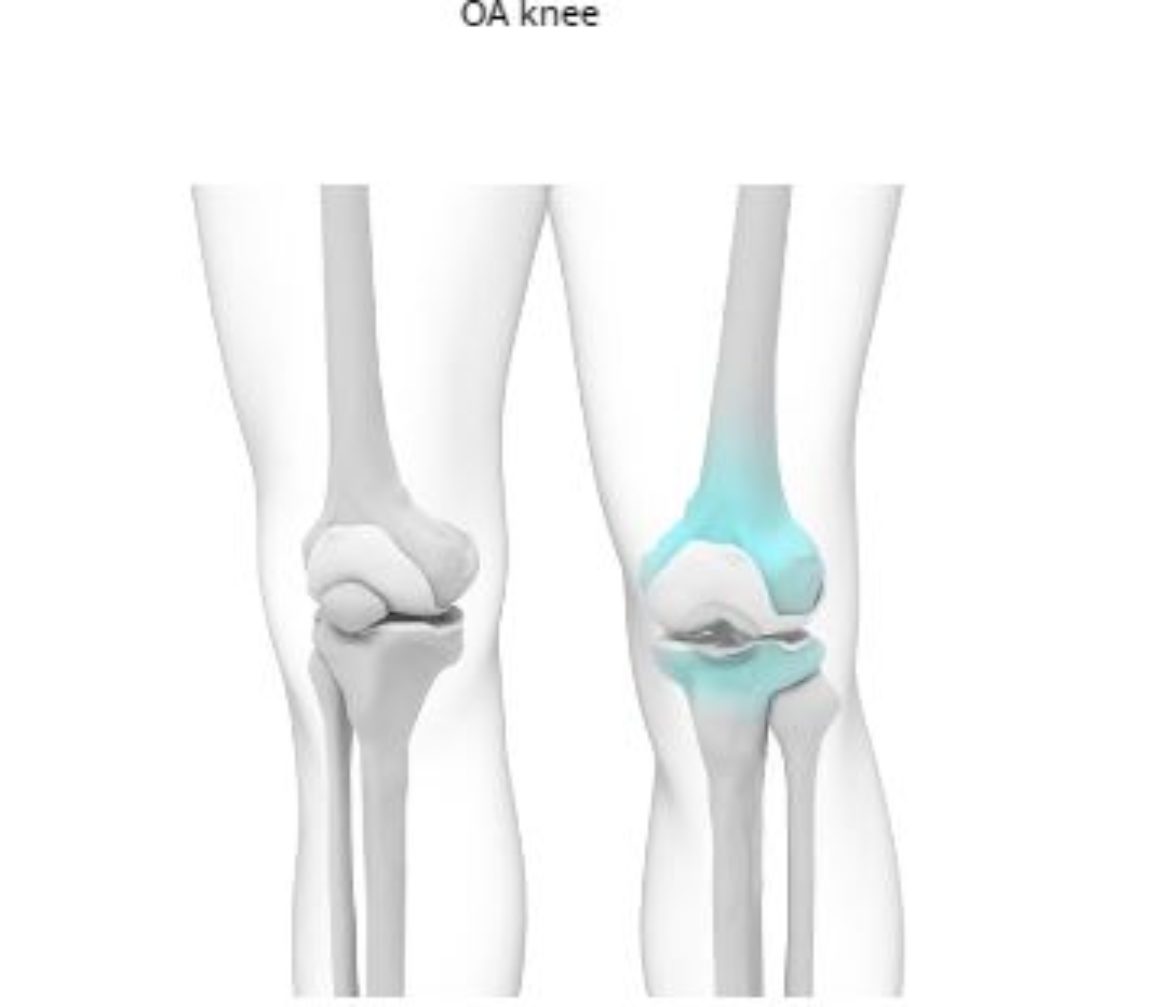 how-common-is-osteoarthritis-singapore-orthopaedic