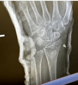 Biological mechanism of shockwave in bone